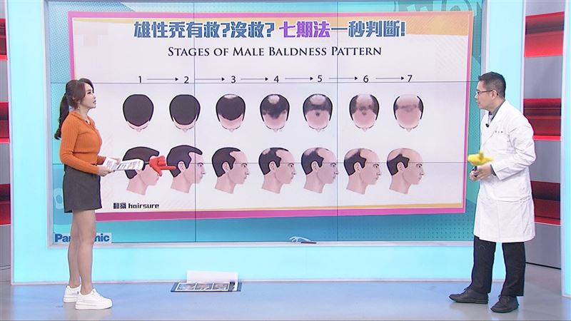 2大壞習慣恐「禿頭」？嗜甜「掉髮」多2倍