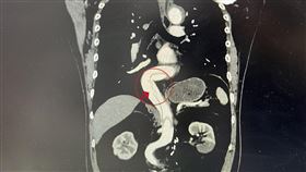 65歲男用力打噴嚏，主動脈一路破裂長達40公分，中港澄清醫院急診室主任鄭清萬(圖／翻攝畫面)
