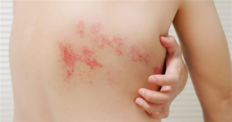 帶狀疱疹引發難以忍受的神經痛。(圖/翻攝自Shutterstock)