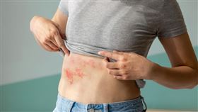 ▲高達99.5%的年長者攜有帶狀疱疹病毒，提升發病的機率。（圖／Shutterstock）