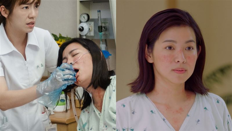 米可白演紅斑性狼瘡病人「虛弱病床照」曝