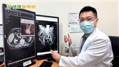 驚見腫瘤！新式腎結石手術大升級避免危機