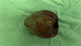 高雄男腹痛因肛門塞椰子  開刀取出高雄50歲男子因肚子劇痛、無法排尿至高雄義大醫院急診，醫師檢查後發現有顆椰子卡在男子直腸中，也因壓迫尿道導致無法排尿。經醫療團隊緊急開刀將椰子取出才解決病症，此案例登上英文外科期刊（British Journal of Surgery）。（義大醫院提供）中央社記者林巧璉傳真  113年3月20日