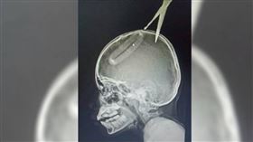 4歲童學電視劇「射飛刀」！姐慘被爆頭　刀片插腦2.5公分深