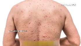 v嘉高中水痘1200