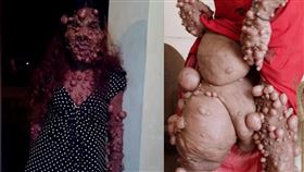 泡泡女全身佈滿上千腫瘤，動25次手術重獲新生，神經纖維瘤（圖／翻攝YT頻道Caters Clips、TLC）鏡週刊