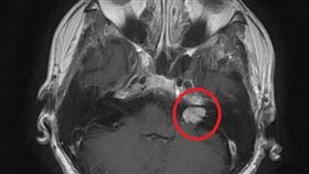 術前核磁共振顯示紅圈處有一小於2公分大的腫瘤。（圖／台北慈濟醫院提供）