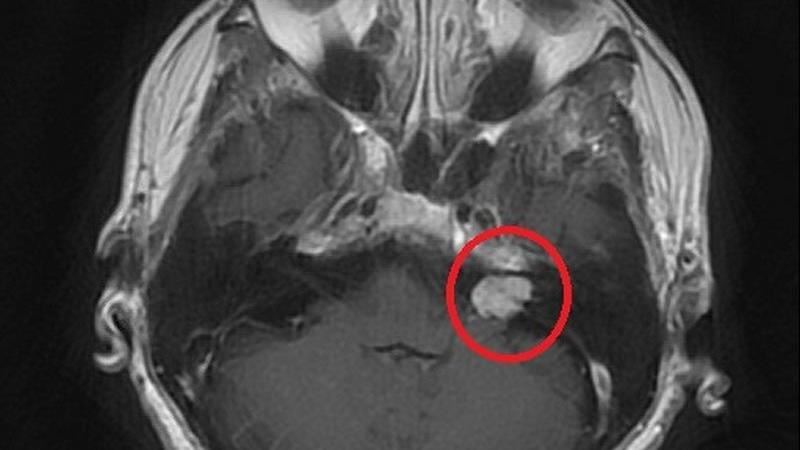常聽見嗡嗡嗡、四肢麻刺感　竟是聽神經瘤