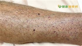 「免疫性血小板缺乏紫斑症」(ITP)是一種因為血小板數量減少造成的出血性疾病，成因不明確。