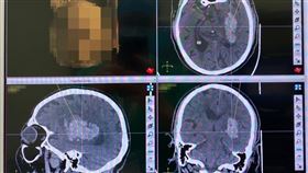 出血性腦中風常見發生原因為病人血壓控制不當，由電腦斷層可發現血塊（白色處）壓迫到腦部細胞。（圖／雙和醫院提供）