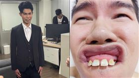 暴牙,鄧佳華,AV,全口矯正牙齒