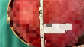 子宮肌瘤（愛麗生婦產科院長潘俊亨）