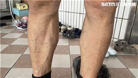 患有靜脈曲張民眾不僅下肢會佈滿宛如蚯蚓般的血管，更有痠痛腫脹等症狀。（圖／翻攝畫面）