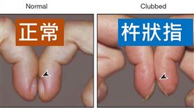 杵狀指。（圖／台東馬偕提供）