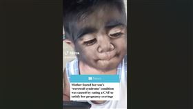 菲律賓一名2歲的男童出生後即異常多毛，長相越來越像傳說中的狼人，男童母親日前自曝，疑因「懷孕期間吃貓咪被詛咒」，引起當地民眾熱議。