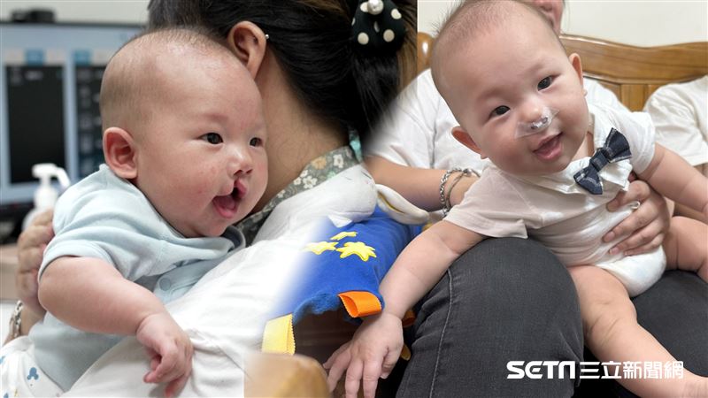 高齡首胎竟是唇裂兒　決定到手術完看哭了