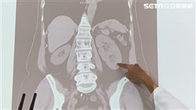 輸尿管結石　台中6旬婦意外發現有3顆腎(圖/翻攝畫面)