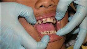 牙齒痛，(示意圖／PIXABAY)