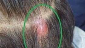 後腦腫塊、禿頭，就醫已是肺癌末期，嚇到戒菸，抗癌6個月濃密黑髮長出來(圖／烏日林新醫院提供)