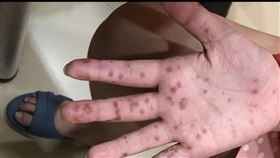 腸病毒個案。（圖／兒科醫師施勝桓提供）