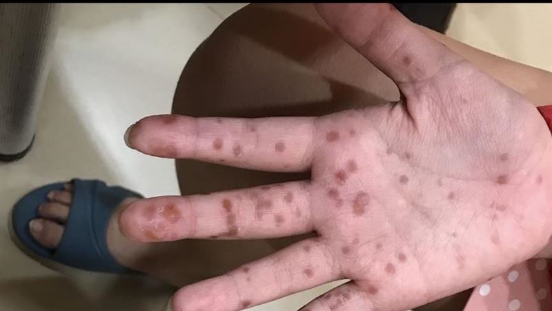 腸病毒月底流行期！醫憂「1族群」超危險