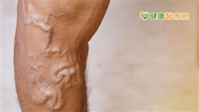 「靜脈曲張」發生原因可能跟遺傳、運動量不足有關。