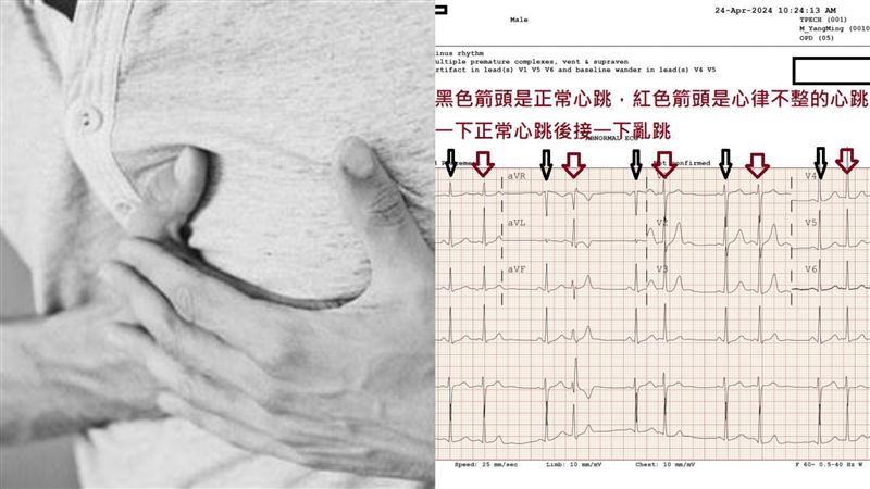 震整晚30歲男心悸加重　醫看完心電圖驚呆