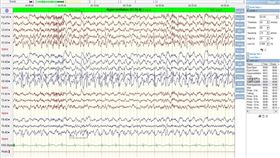 閃光,糖尿病,高血糖,癲癇（圖／台北榮民總醫院新竹分院提供）