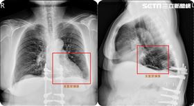 老婦喉嚨卡卡！一驗竟是「支氣管塞滿痰」（圖／翻攝畫面）