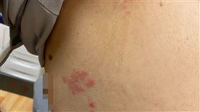 病人左胸水泡般疹子，是帶狀疱疹作祟。（圖／台中慈濟醫院提供）