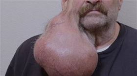 美國有名男子2007年發現耳邊長了小顆粉刺，沒想到這顆粉刺越長越大，最後竟高達5.5磅重。（圖／翻攝FB／