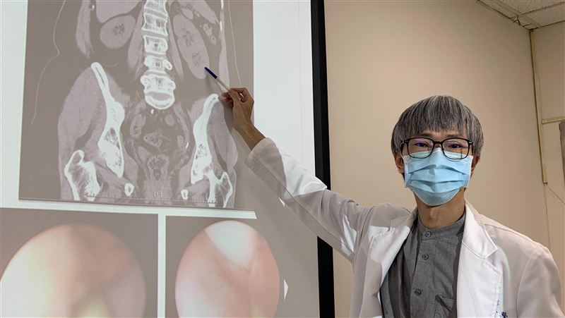 健檢發現輸尿管結石　驚見這女人有三顆腎