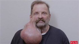 ▲美國男子2007年發現耳邊長了小顆粉刺，豈料粉刺越長越大，最後竟重達5.5磅重。（圖／CTWANT提供）