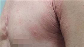 過敏水腫生在喉頭，會阻塞上呼吸道甚至可能致命。（示意圖／台中慈濟醫院提供）