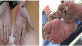 服用Regorafenib病人產生的手足皮膚反應，紅疹出現在手掌(左)和腳掌（右）。（圖／林口長庚醫院提供）