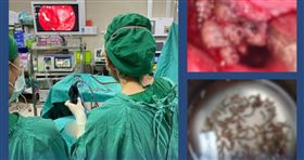 老婦鼻血狂流！醫一照驚見「大片白色蠕動」　鼻腔夾出百條蛆蟲