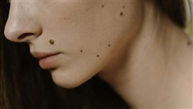 痣不只影響美觀，還可能對身體造成影響。（示意圖／翻攝自Pexels）