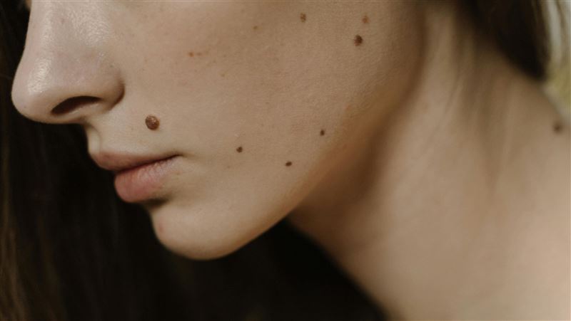 這些黑痣建議割！醫：恐病變惡性黑色素瘤