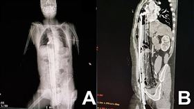 91公分鋼條從下體插入頂到肺！變「人肉烤串」貫穿全身　他奇蹟存活