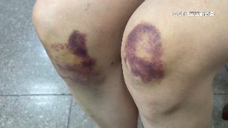 女控立榮航空作業疏失　害趕登機慘摔瘀青