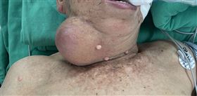 病患術前照，腫瘤非常巨大，檢驗結果顯示是罕見腮腺癌肉瘤。（圖／長安醫院提供）
