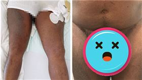 瑞士一名72歲男子因感染寄生蟲，導致生殖器腫脹如棒球大小。（圖／翻攝nejm.org）