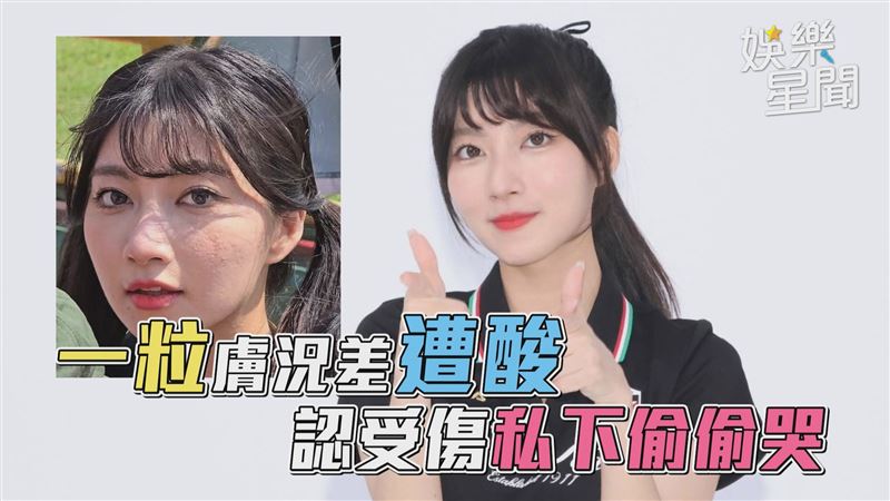 一粒膚況差遭酸　認受傷私下偷偷哭QQ