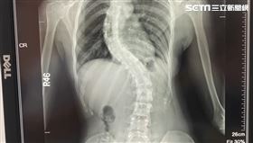 15歲妹身高僅145cm!X光一照「脊椎S側彎」（圖／翻攝畫面）