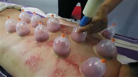 ▲Youtuber亿民拍攝影片，記錄初次拔罐的體驗過程。（圖／Yeemin亿民 授權）