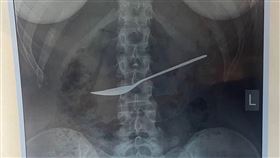 午飯完肚子痛！女童照X光驚現「胃裡有20公分湯匙」（圖／翻攝自Ｘ）