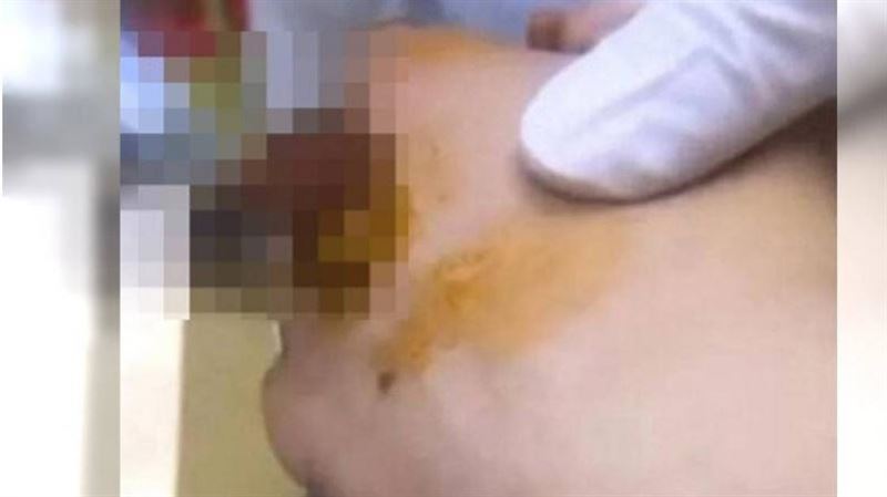21歲男工傷斷指！接回長出「80條活蛆」