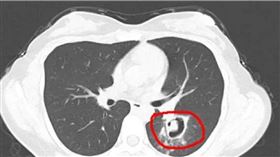 她肺部長「小樹芽」竟是發霉了！醫化驗秒懂：1動作害的