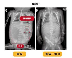 迴腸閉鎖、腸扭轉穿孔　台中女嬰開刀搶命(圖/翻攝畫面)