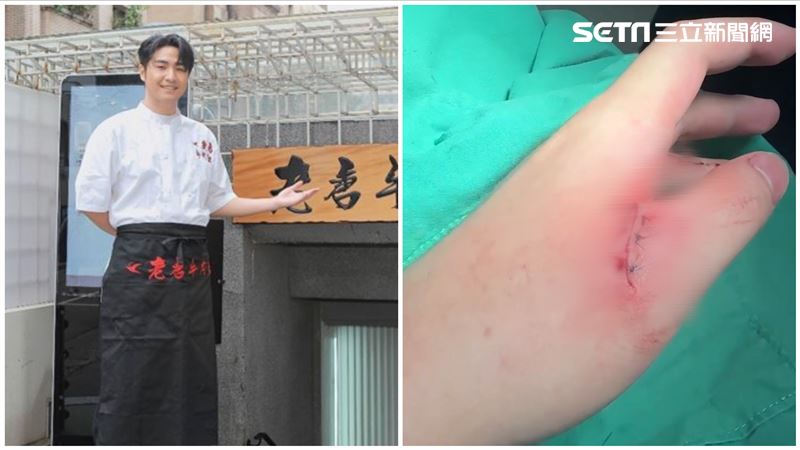 鹿希派還原噴血過程！縫5針傷勢照首曝光